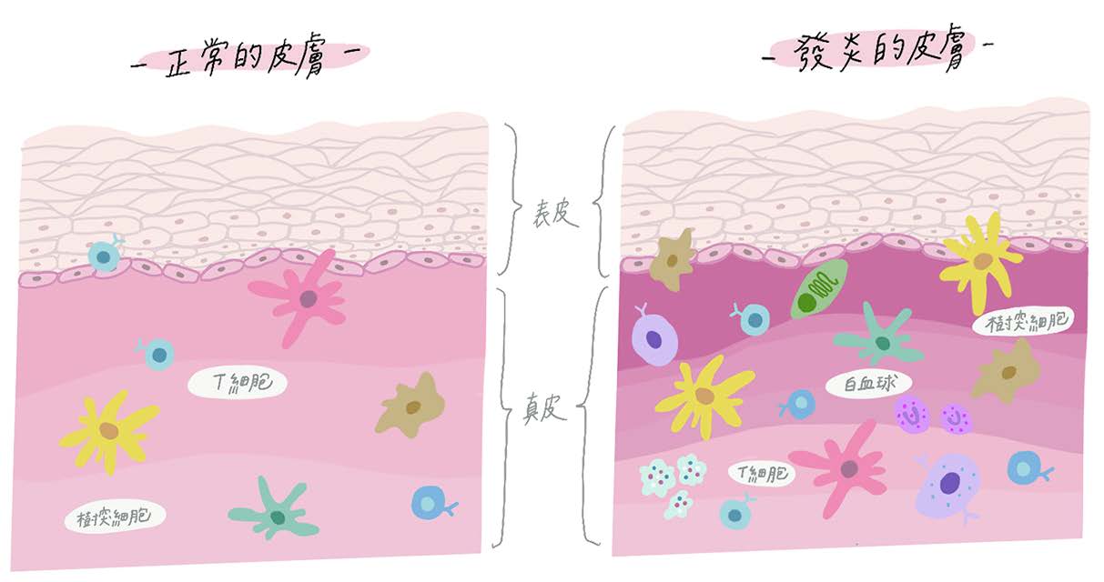皮膚是人體最大的免疫器官