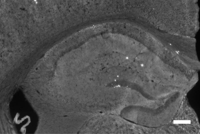 找到阿茲海默症治療的可能方向？