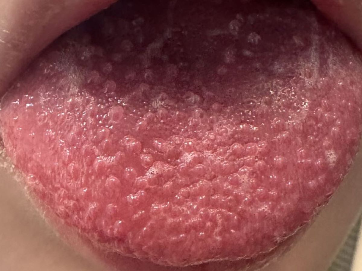 男童高燒不退合併草莓舌 竟是猩紅熱作怪