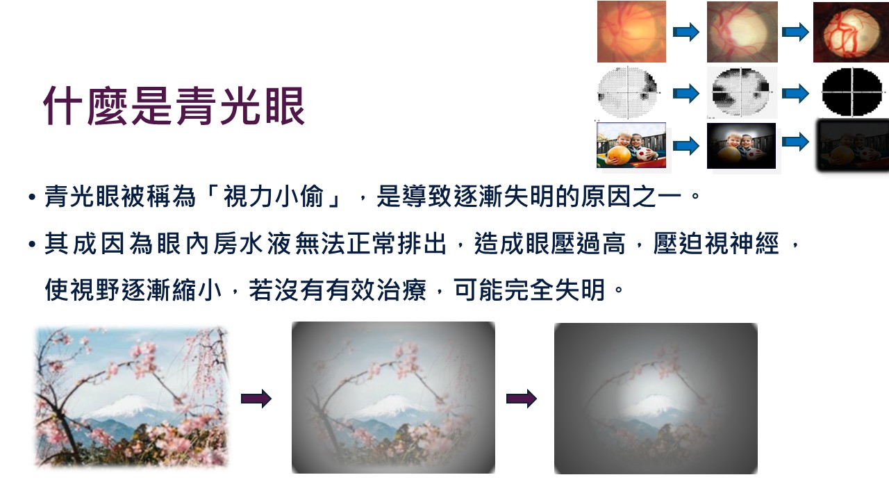 微創青光眼手術——青光眼治療新選擇