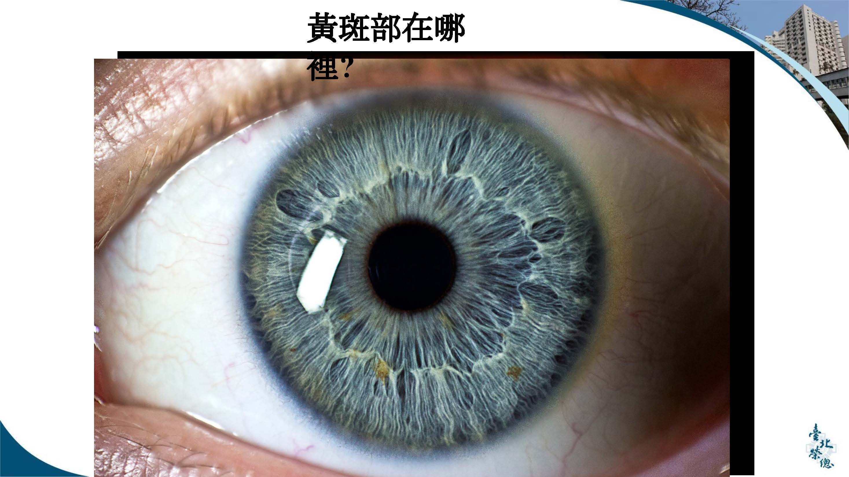 找出黃斑部皺褶視力惡化關鍵　早期手術恢復快預後佳