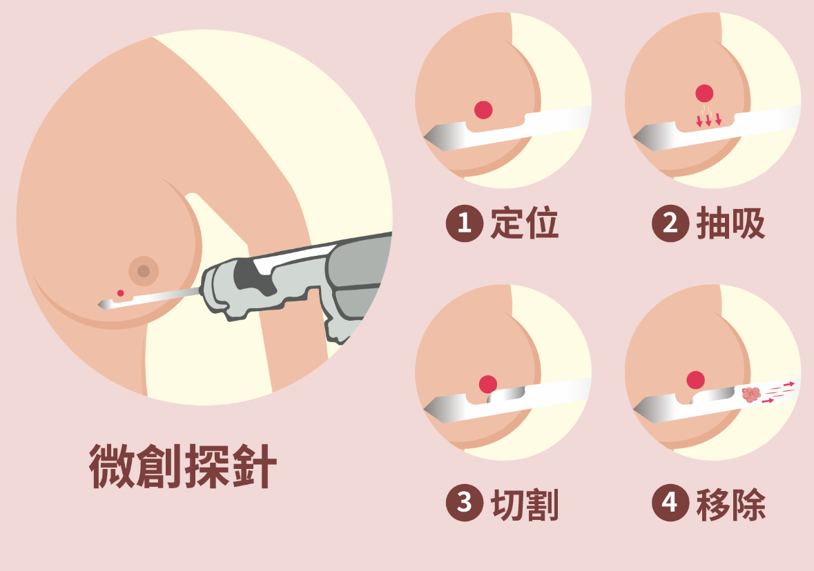 乳房良性腫瘤的微創手術