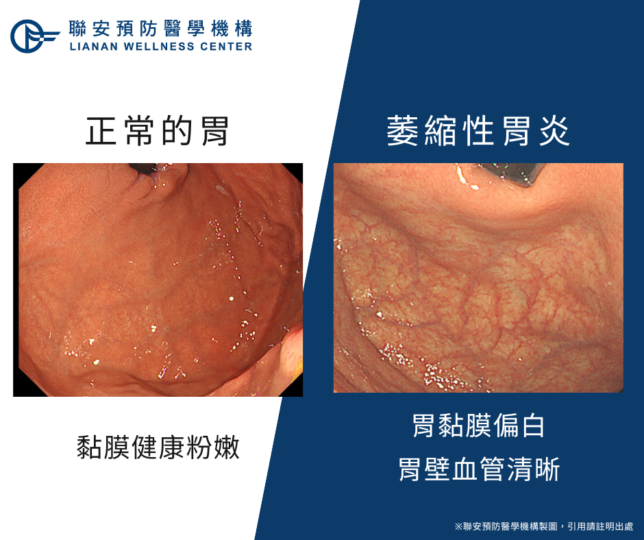 胃癌前期病變？！健檢數據說每10人就有1人罹患萎縮性胃炎