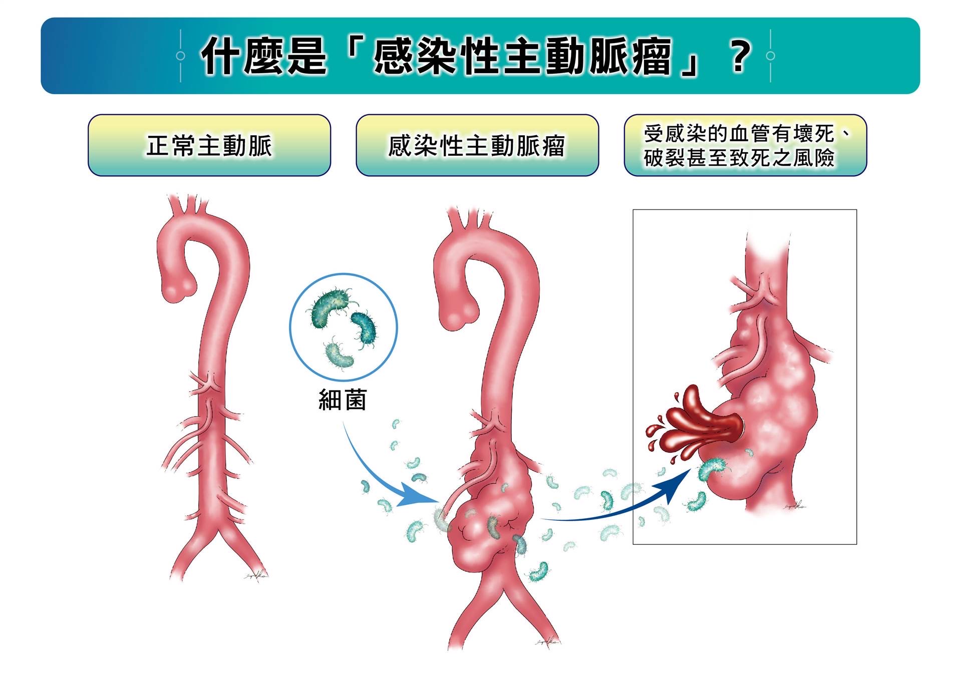 感染性主動脈瘤的開放性手術修補仍為長期救命關鍵