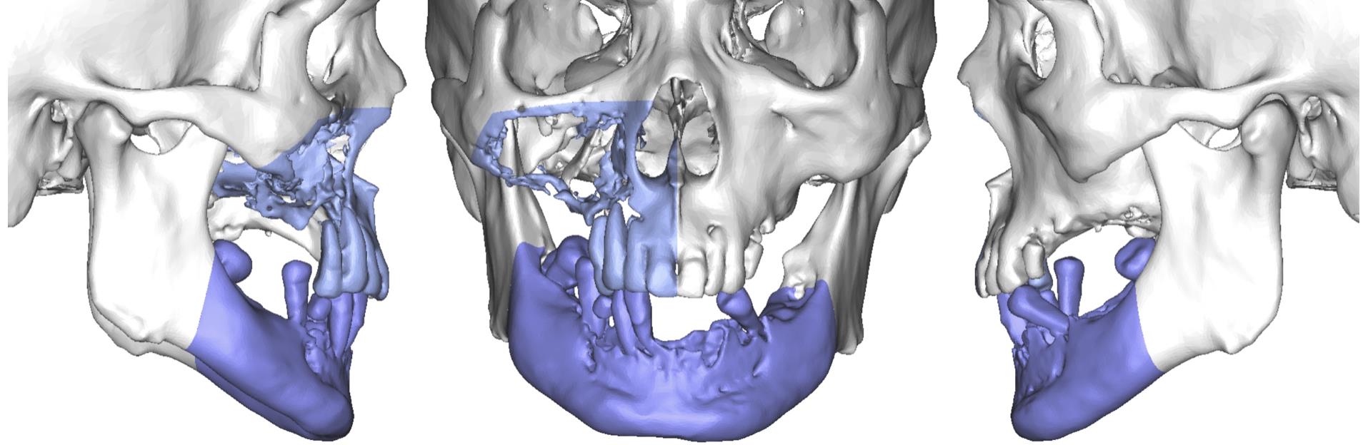 3D列印顱顏重建，整形外科重繪生命的臉龐