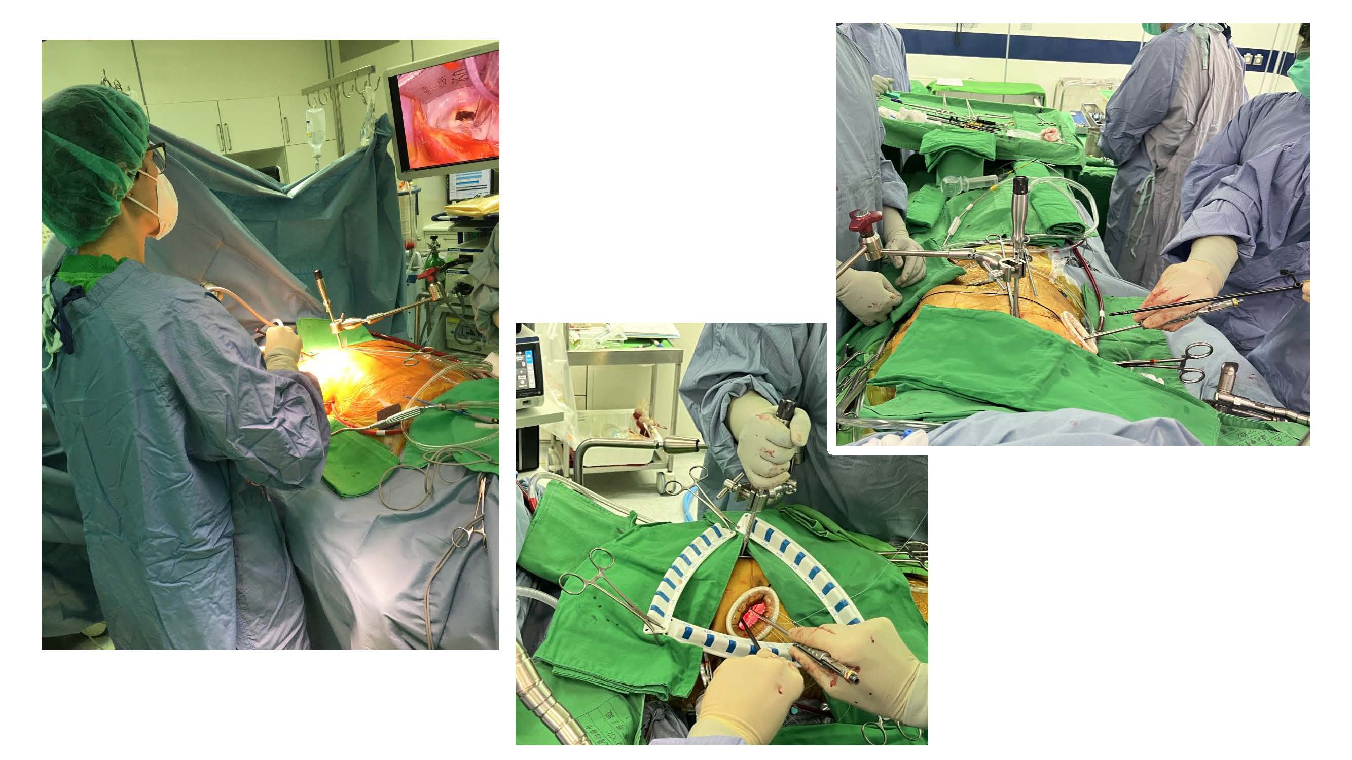 內視鏡微創瓣膜手術結合早期拔管傷口小、疼痛少、恢復快