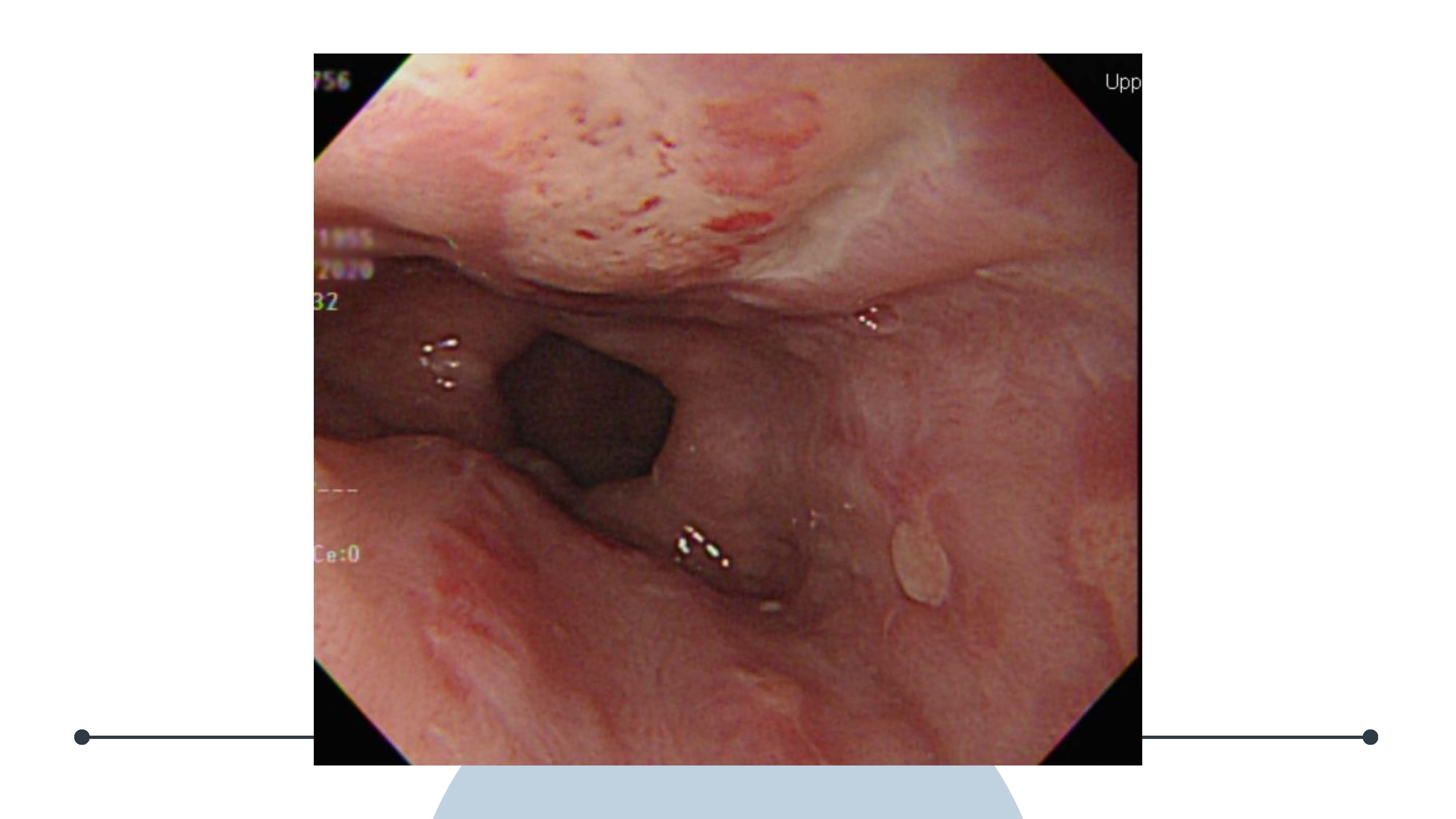 胸悶、胸痛也有可能是食道有狀況！