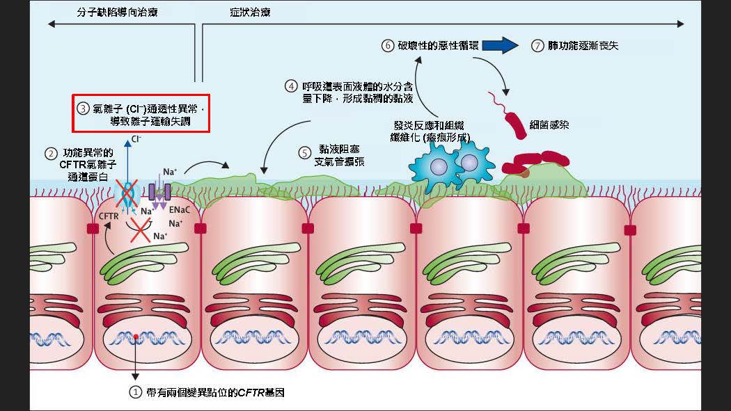 影響全身的遺傳性疾病——囊性纖維化