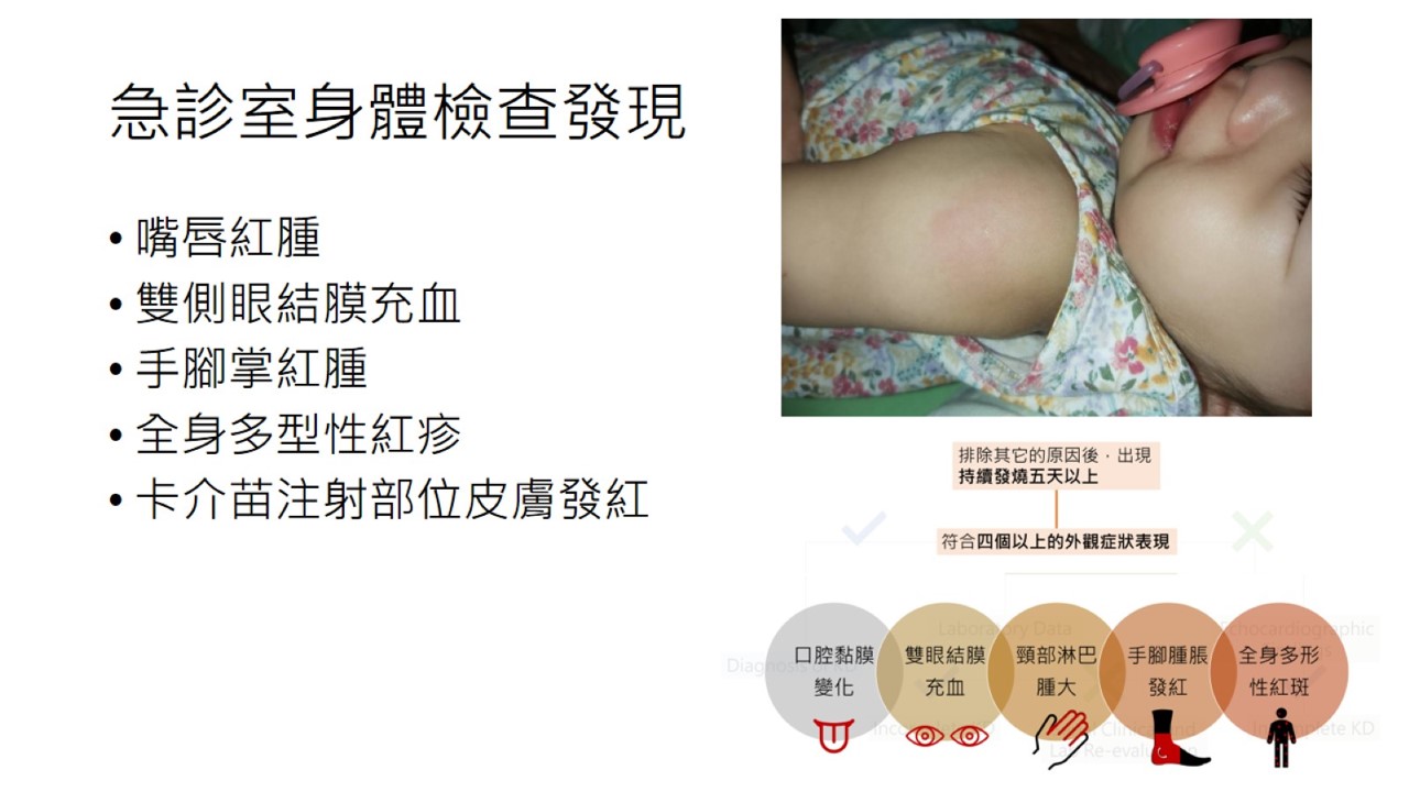 幼兒持續發燒，及早注意是否有川崎病徵兆！