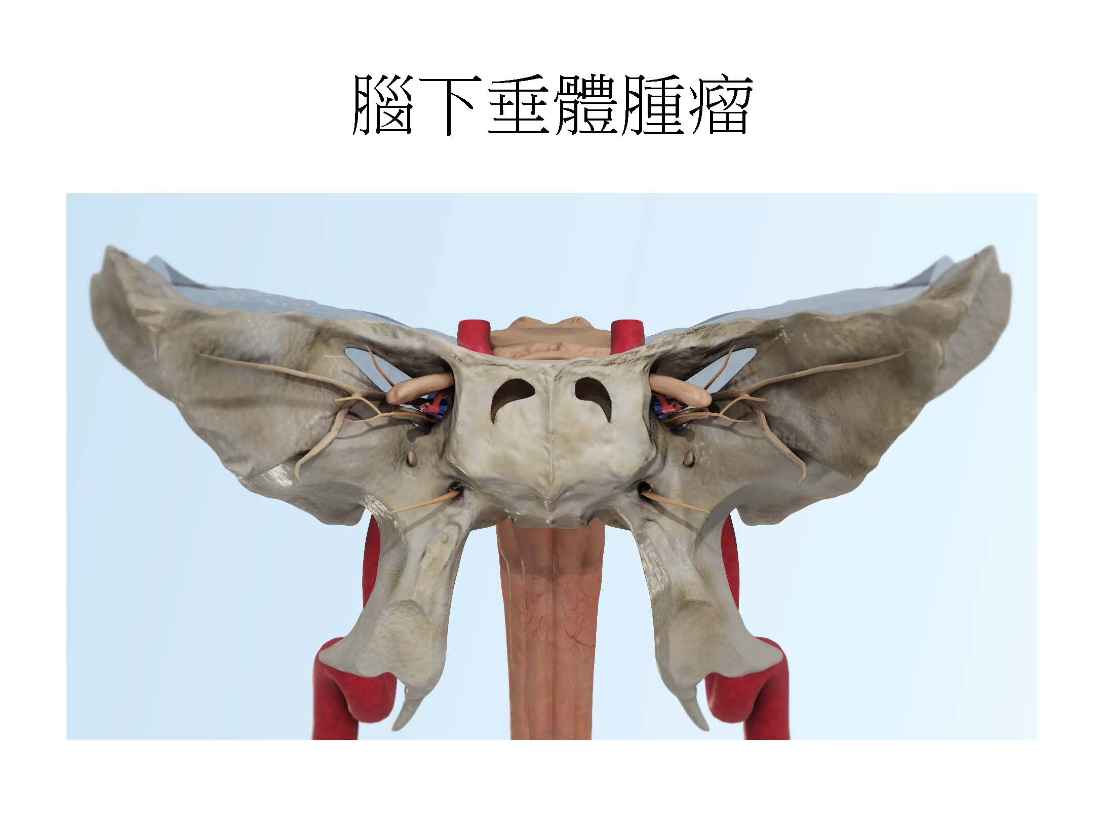 腦下垂體腫瘤引發內分泌多重風暴的治療